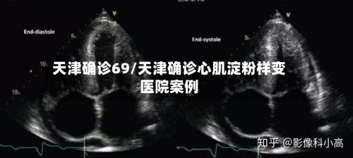 天津确诊69/天津确诊心肌淀粉样变医院案例
