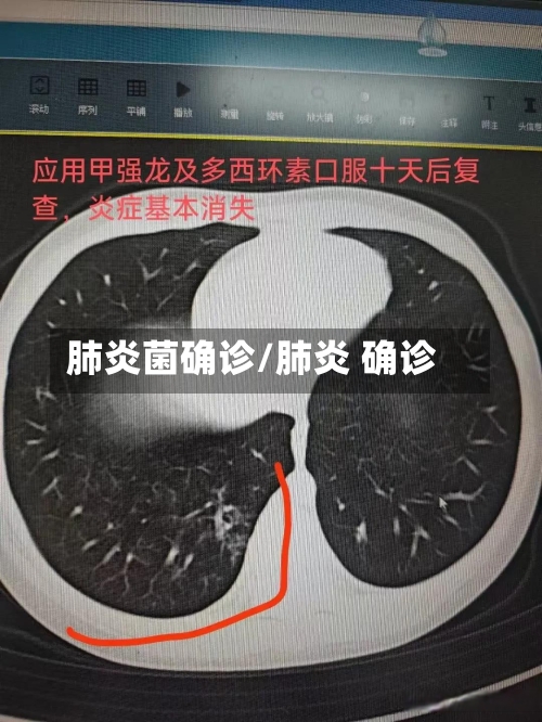 肺炎菌确诊/肺炎 确诊