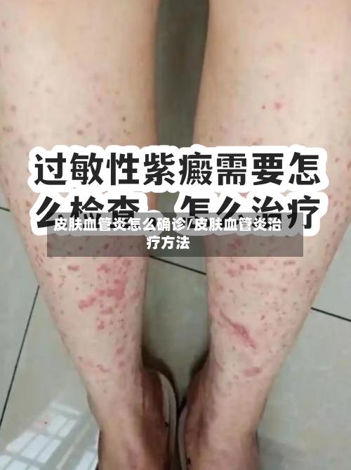 皮肤血管炎怎么确诊/皮肤血管炎治疗方法