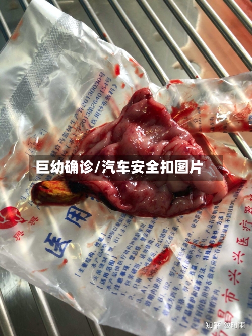 巨幼确诊/汽车安全扣图片